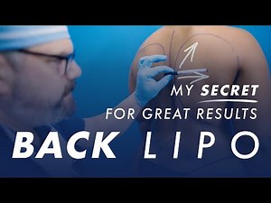 My Secret for Great Results - Back Liposuction