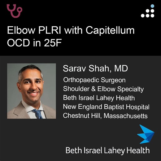 Here are intraop & postop images of yesterday's case by Dr. Sarav Shah and New England Baptist Hospital. ELBOW PLRI WITH CAPITELLUM OCD IN 25F PROCEDURE: 1. LUCL reconstruction 2. Capitellum Osteochondral Autograft Transplantation from Knee 3. Iliac Bone Marrow Aspirate Concentrate HPI: The patient is a 25-year-old left-hand-dominant female who presents to the outpatient clinic for evaluation of left elbow pain. She reports the acute onset of sharp, severe pain approximately three weeks prior wh