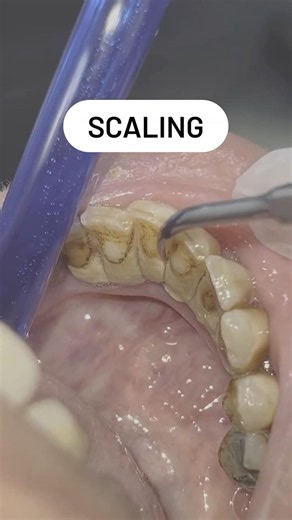The Most Satisfying Tartar Removal You’ll See Today! 🦷✨ ASMR