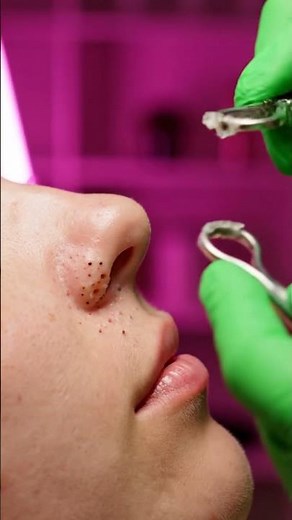 Huge Blackheads Removed From Nose! | So Much Sebum! Deep Nose Cleaning