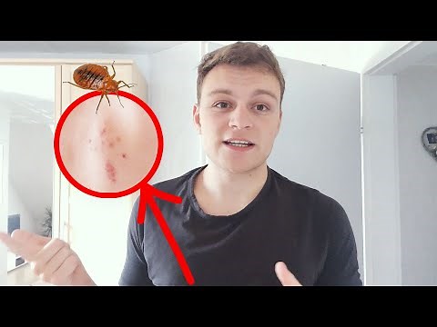 Bed Bug Bites Treatment for Healing (What worked for me)