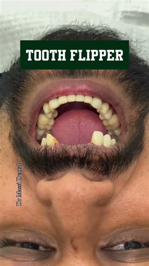 PARTIAL DENTURE