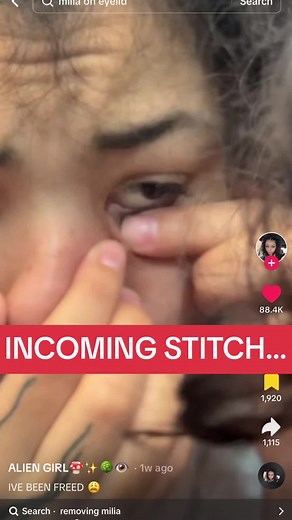 Satisfying Milia and Sebum Plug Extractions | Skincare Tips