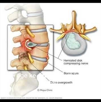 why mri spine is more important #mri #spine #disc mri