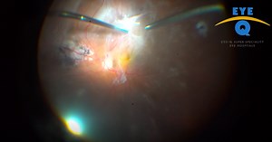 Management of Atypical Tractional Retinal Detachment - Eyetube