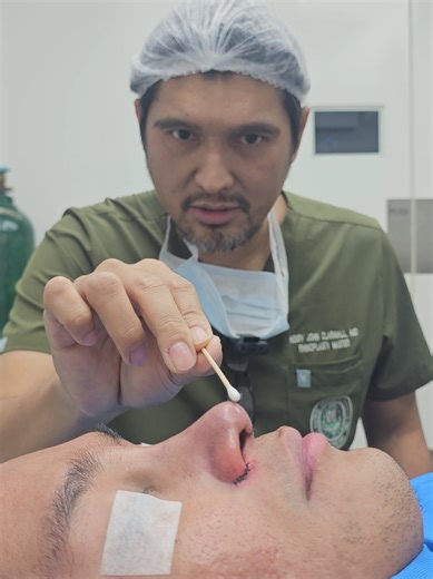 Septorhinoplasty for Correcting Deviated Septum