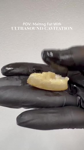 ULTRASOUND CAVITATION DEMONSTRATION ⚡️ We used pork fat to demonstrate how ultrasonic cavitation works in our SLIM PACKAGE TREATMENT. The fat gets broken up & liquified, then your body naturally flushes it out through the lymphatic system 3-5 days after treatment. You can literally see the piece of fat melt 😍 #ultrasoundcavitation #cavitation #cavi #stubornfat #wieghtloss
