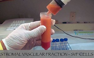 Stromal Vascular Fraction (SVF) cells