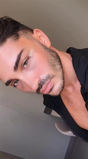 Fox Eye Surgery: 1 Year Transformation Journey