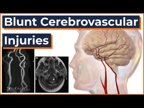 Blunt Cerebrovascular Injuries