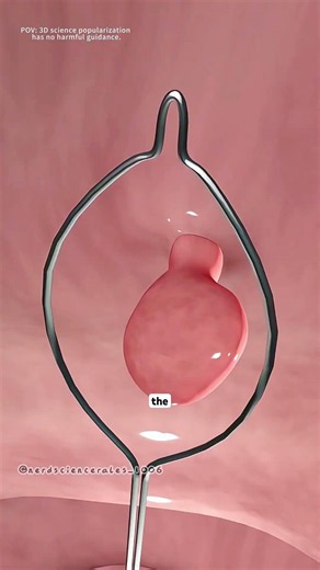 Colonoscopy procedure (3D animation) #paliativecare #theflash #3danimation #science #leakygut