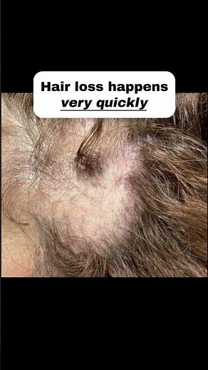 Alopecia Areata: Early Signs You Should NEVER Ignore