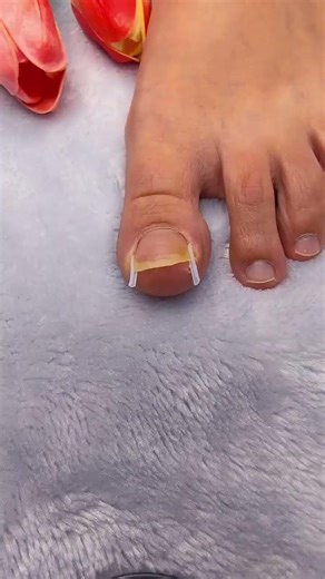 Five Toe Separator Corrector for Alignment, Pain Relief and Foot Care Aid