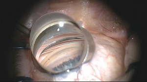 Excisional Goniotomy With the Kahook Dual Blade, Using Trypan Blue - Eyetube