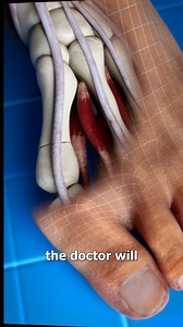 3.7M views · 33K reactions | Bunion Correction  (explained) | Zack D. Films | Facebook