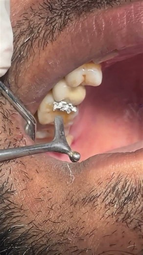 Amalgam filling #dental #dentist