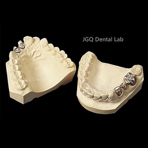 [Hot Item] Pfm Dentures Posterior Anterior Metal Ceramic Crown Long-Lasting Dental Restorations Best Price