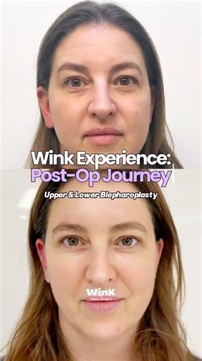 Upper & Lower Blepharoplasty Recovery Result: 1 Month Post Op