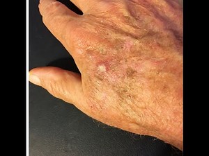 Watch the Removal of a Pre-Cancerous Skin Lesion (Actinic Keratosis) | Skin Cancer Prevention