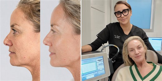 Tamzin Outhwaite has £5k non-surgical facelift at 55 after sagging skin began ‘getting her down’