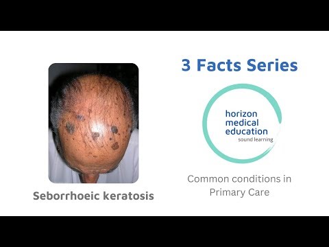 #3facts: #Seborrhoeickeratoses |Seborrheic warts | old age wart| Wisdom wart |Barnacle wart