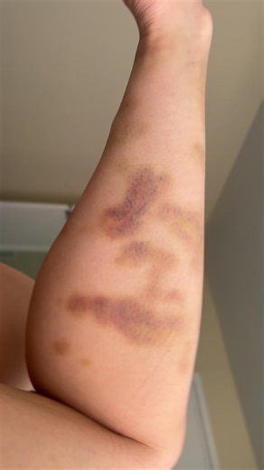 Surviving Abuse: My Night of Violence and Fear
