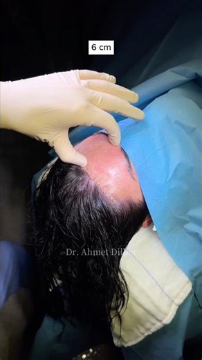 Forehead Reduction 💆🏻‍♀️ Dr. Ahmet Dilber ✨ #foreheadreduction #hairlinelowering