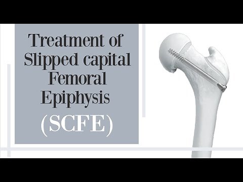 treatment of slipped capital femoral epiphysis SCFE - hip pain in children