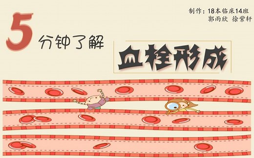 【病理学】害怕血栓？——5分钟了解血栓形成