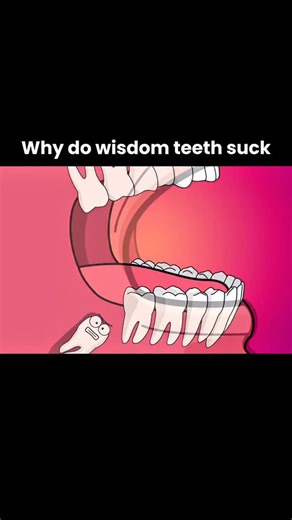 Healthy_Life_Strong on Instagram: "Wisdom teeth often cause problems because modern human jaws are smaller and don’t have enough space for them. When they try to erupt, they can become impacted, grow sideways, or only partially come out—leading to pain, swelling, infection, and damage to nearby teeth. They’re also hard to clean, so food and bacteria get trapped easily, increasing the risk of cavities and gum disease. #wisdomteeth #toothpain #impactedteeth #dentallife #oralhealth #jawpain #dentis