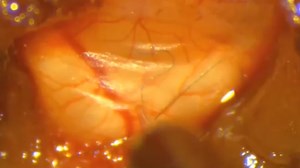 Double Direct Injection of Blood into the Cisterna Magna as a Model of Subarachnoid Hemorrhage