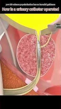 Male Urinary Catheter Installation#urinarybag #urinarycatheter #urinarycatheterization #urinebag