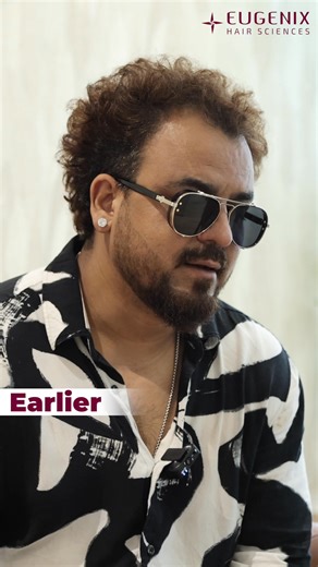Toshi Sabri's Stunning Hair Transplant Journey at Eugenix Hair Sciences In this exclusive video, renowned Indian Singer and Musical Composer Toshi Sabri shares his personal experience undergoing a hair transplant procedure at Eugenix Hair Sciences. "My hair has always been my identity," says renowned Indian Singer and Musical Composer, Toshi Sabri. Known for his powerful vocals on Bollywood hits like Maahi and Kawa Kawa, Toshi's signature curly hair was a vital part of his image. In this candid 