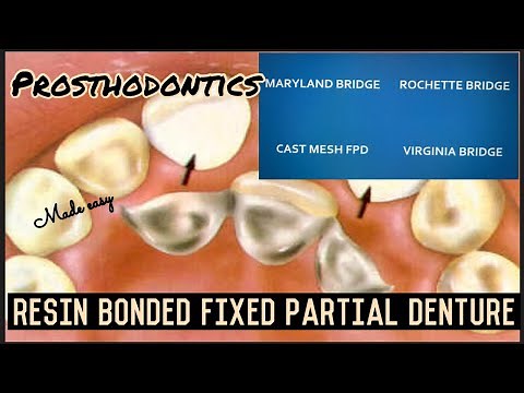 RESIN BONDED FIXED PARTIAL DENTURE II ROCHETTE, MARYLAND, CAST MESH, VIRGINIA BRIDGES II FPD II easy