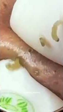 #relax#acne#satisfying#asmr#earwaxremmoval#earcleaningvideos#earwaxcleaning#ceradeouvido