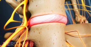 What Is Degenerative Disc Disease?