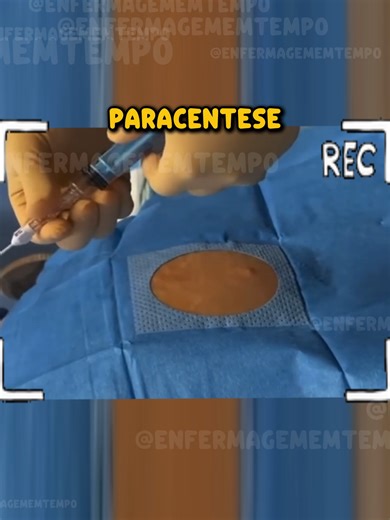Paracentese #enfermagem #saude #nurse #paracentese #doenca #fyp #viral #medicina