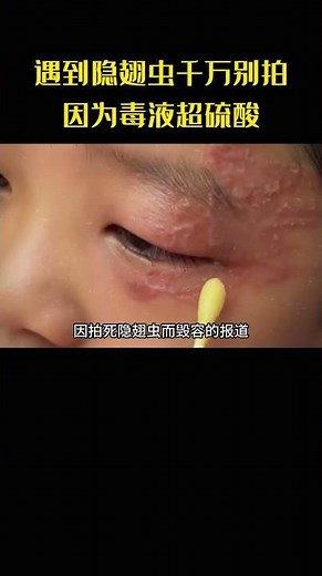 隱翅蟲落身千萬別拍死！其毒液腐蝕性超硫酸，只需輕輕吹走#隱翅蟲#科普