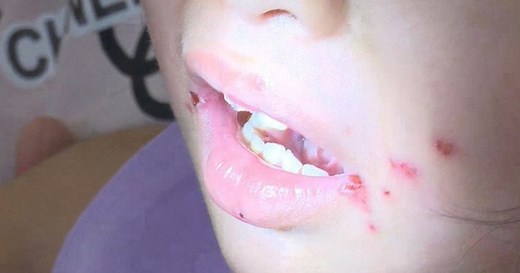 TP. Hồ Chí Minh: Enterovirus 71 gây bệnh tay chân miệng nặng ở trẻ em đã xuất hiện trở lại