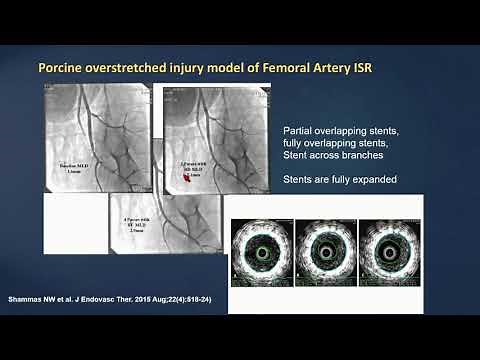 Jetstream Atherectomy – Why, When, and How? - Nicolas Shammas, MD