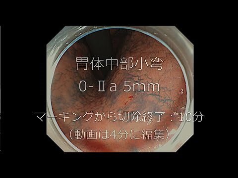 消化器内科『胃 ESD（内視鏡的粘膜下層剥離術）』4分編集動画