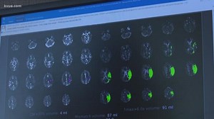 Tech Tuesday: Saving lives from strokes with new rules and equipment