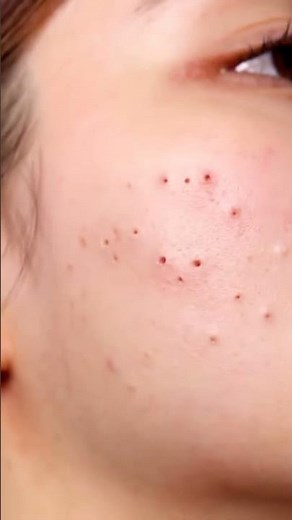 Nose Pore Unclogging — ASMR