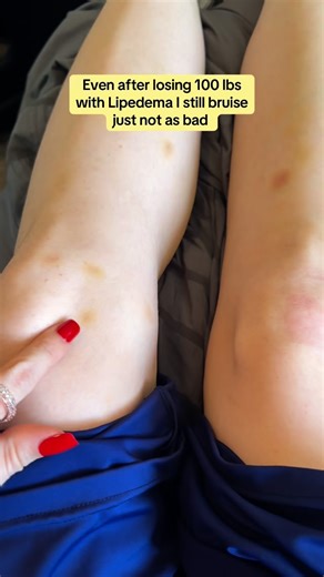 💜 One of the strangest symptoms of Lipedema is easy bruising. Even after losing 100 lbs, I still wake up almost every single day with new bruises I can’t explain 🤪 The difference now is—they’re so much lighter than before. I used to be covered in deep, dark bruises constantly, and it’s such a relief to see them ease up as I’ve focused on inflammation and self-care. 👉 Can you relate? Do you wake up with random bruises too? #Lipedema #LipedemaAwareness #ChronicIllness #InvisibleIllness #BodyPos