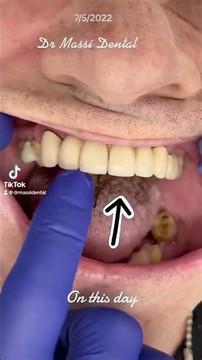 Wiggle wiggle teeth , loose teeth