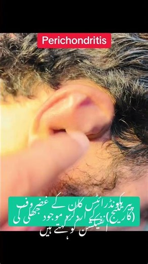 Perichondritis is an infection and inflammation of the perichondrium (the connective tissue layer✌️