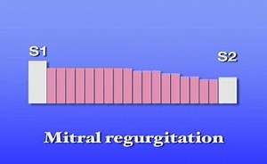 Mitral Regurgitation