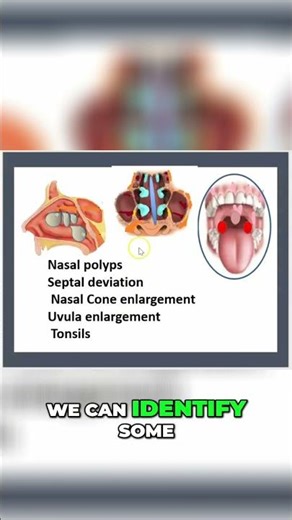 Snoring: Risks, Causes, and Solutions Explained #shorts
