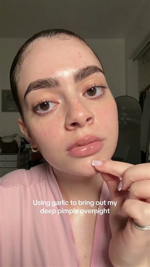 Garlic for deep cystic acne #short #shorts #updoll