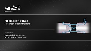 FiberLoop® Suture for Tendon Repair in the Hand